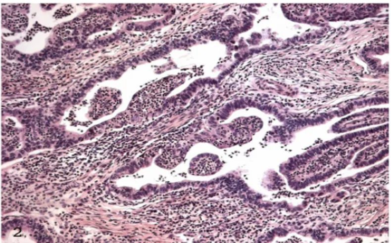 Figure 3: Large areas of tumor necrosis without neutrophil infiltration. H &amp;E x 100