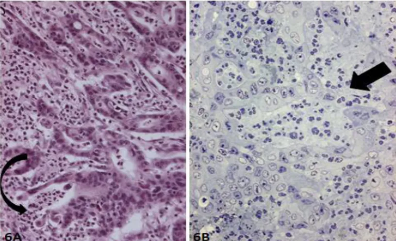 Figure 6A: Neutrophil transepithelial migration associated with focal neoplastic gland disruption (curved arrow)