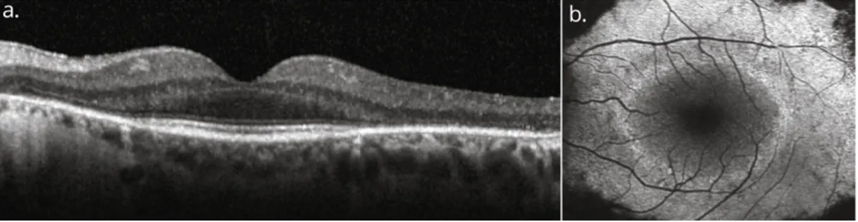 Fig.  3.  Horizontal  spectral-domain  optical  coherence  tomography  (SD-OCT;  a)  and  fundus  autofluorescence  (FAF; b) images of the left eye of a patient with RP