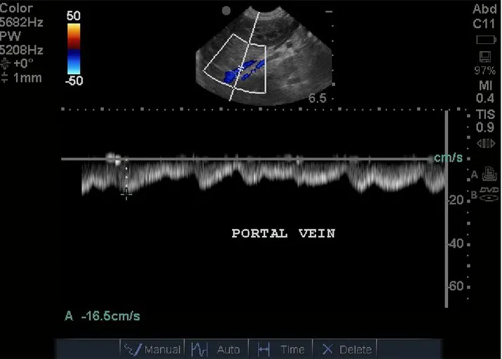 FIG 9: Flusso portale normale.