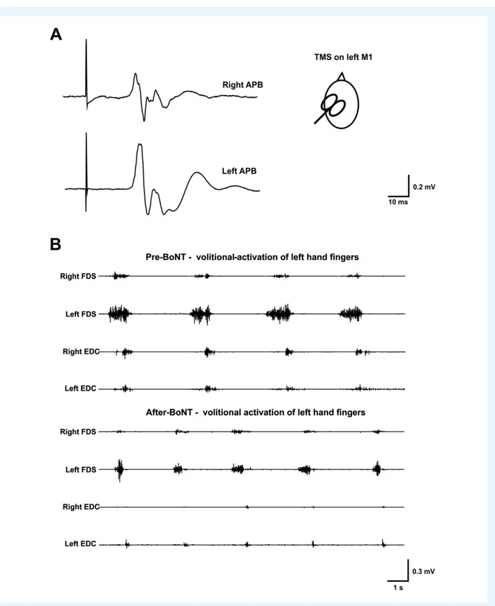 FIG. 1. A: Transcranial magnetic stimulation (TMS) of the left primary motor area (M1) induced a contralateral motor-evoked potential (MEP) (on the right abductor pollicis brevis [APB]) and an ipsilateral MEP (on the left APB)