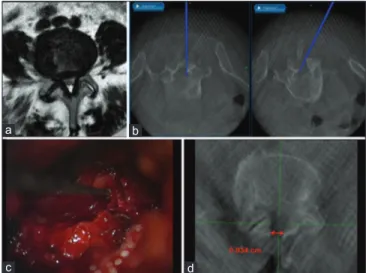 Figure 1: An example of the intraoperative use of neuronavigation for the  minimally invasive unilateral laminotomy with crossover in a case of lumbar  degenerative stenosis