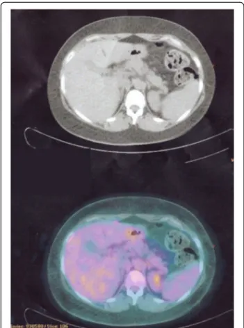 Fig. 1 CT/PET scan showing CR in the liver lesions