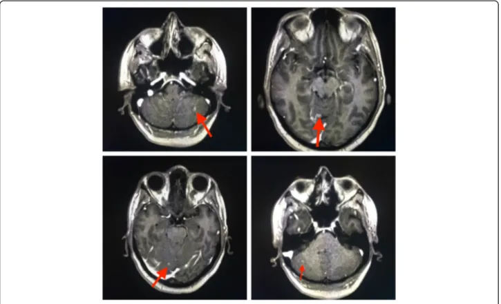 Fig. 2 April 2016, Brain MRI showing multiple brain and leptomeningeal metastases
