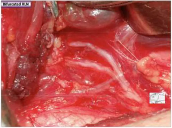 Figure 1. Intraoperative identification of a bifid recurrent laryngeal nerve 
