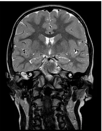 Figure 2.   T2-weighted magnetic resonance imaging (MRI) of the  brain shows the cholesteatoma of the right middle ear.