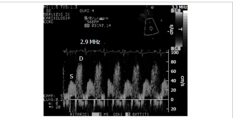 FiGURe 1 | Example of coronary flow Doppler signal during dypiridamole-induced hyperemia