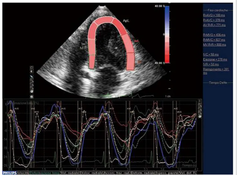 FiGURe 2 | STE: systolic myocardial deformation after electromechanical activation. LV: longitudinal strain from the apical four-chamber view: time–strain curves 