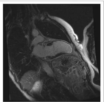 FiGURe 3 | CRMI: a patient with previous anterior myocardial infarction. Late 