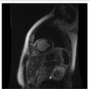 FiGURe 4 | Cardiac CT: patient with high-grade left anterior descending 