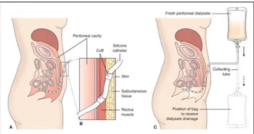 Figura 1.4 Catetere di Tenckhoff e meccanismo di funzionamento della dialisi peritoneale