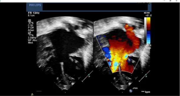 Figura 4. Ecocardiogramma color-Doppler, proiezione 4 camere apicale di canale atrio-ventricolare  completo con lieve dominanza destra