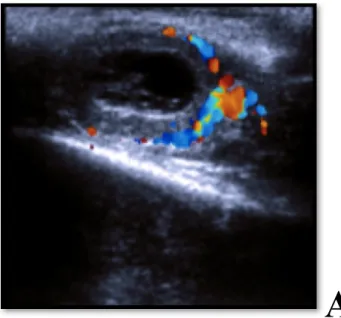 Fig.  5  -  Esempio  di  identificazione  dell’arteria  spirale  luteale  e  rilievo  delle arterie capsulari in un CL 8 GG PE in modalità CFM (A) e modalità  PFM (B)