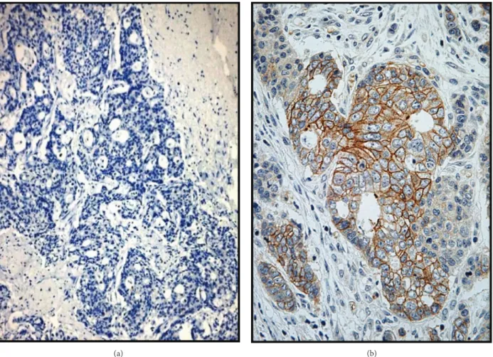 Figure 1: Cribriform gastric carcinoma (CGC): absence of HER2 immunoreactivity (a, original magniﬁcation ×160); a strong 3+ HER2 expression in another case (b, original magni ﬁcation ×240) (Meier Haemalum nuclear counterstain).