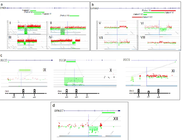 Figure 1. Graphic view of 12 causative copy number variants (CNVs). Gene representation and array CGH panels showing: (a) 4 DMD deletions (patients I–IV); (b) 