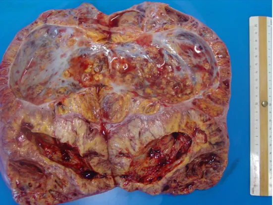 Fig. 3. L’ovaio sinistro neoplastico alla superficie di taglio. 