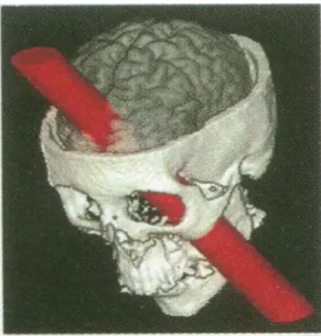 Fig. 1. Fonte: Damasio H. et al. (1994), p. 1104 