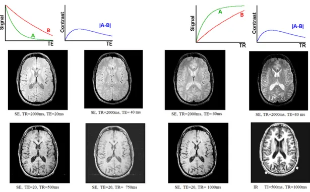 Figure 16 - Example of brain images weighed in a different way and with  different contrast (Courtesy of Dr Silvia Capuani)