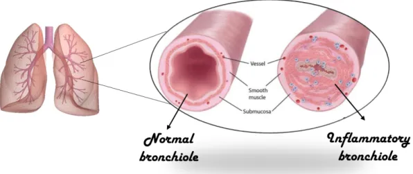 Figure 5. Airway lumen in normal condition and during BOS 