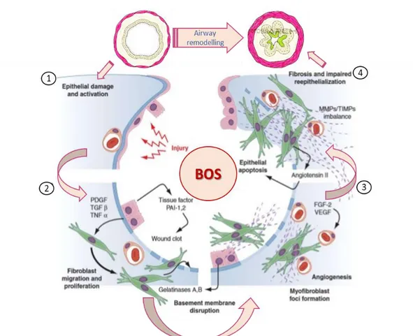 Figure 6. Pathophysiology of BOS 