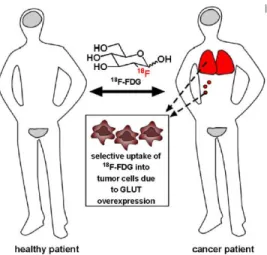 Figure 1.2.  Localization of  18 F-FDG in healthy (grey) and cancer (red) patient. 