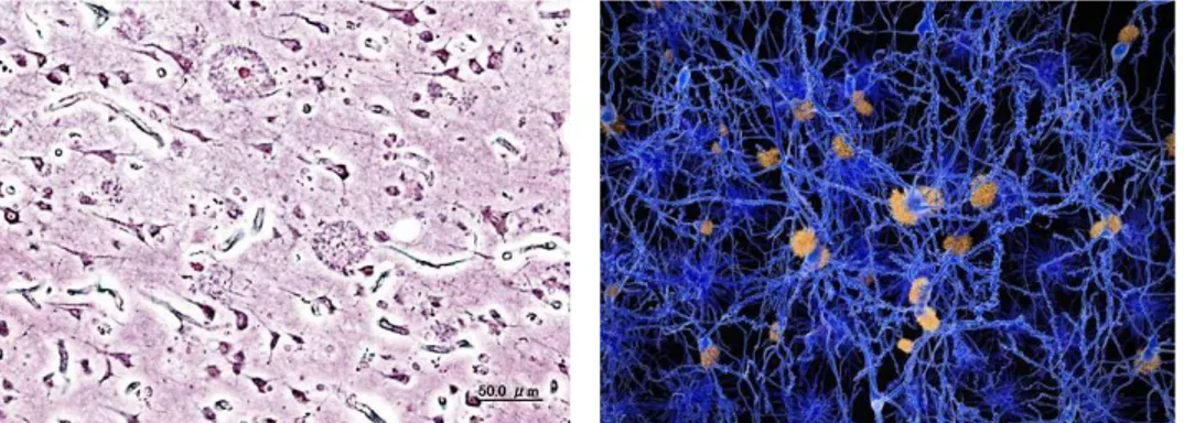 Fig. 1 (a) Histopathologic image of neuritic plaques in the cerebral cortex in a patient with Alzheimer 