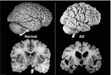 Fig. 3 Brain atrophy in advanced Alzheimer’s Disease 