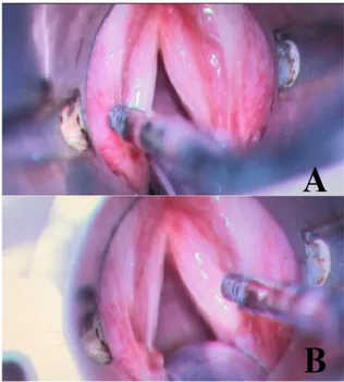 Figure  1.  Injection  of  Botulinum  Toxin  A  in  both  vocal  fold  in  the  lateral thyroarytenoid muscles