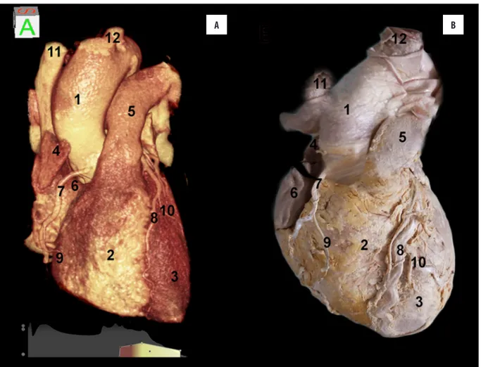 Figure 2.   (A) 3D reconstruction of the heart in a frontal view shows the right atrium and ventricle separated by the anterior atrioventricular groove, 
