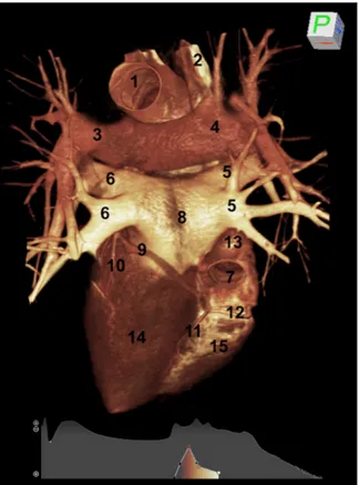 Figure 3.  CT rendering of the diaphragmatic surface of the heart 