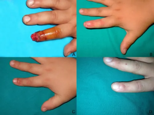 Fig.  6. A 4-year-old child has his right index ﬁnger crushed by an electrical gate, with extensive destruction of the nail-bed  (A)