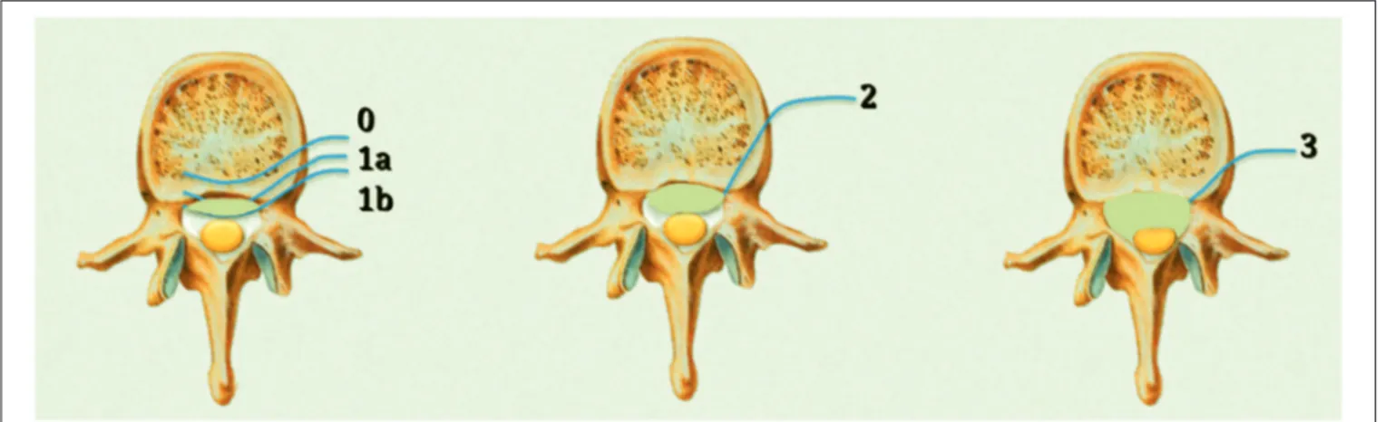 FIGURE 1 | Bilski classification of epidural spinal cord compression (ESCC).