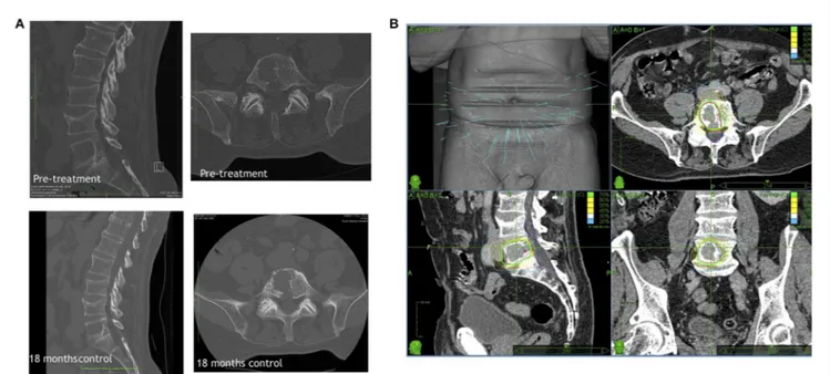 FIGURE 2 | A representative primary Cyberknife treatment case showing (A) the CT scan of the lesion before and 18 months after the treatment visualizing the stable lesion and (B) the Cyberknife therapy planning.