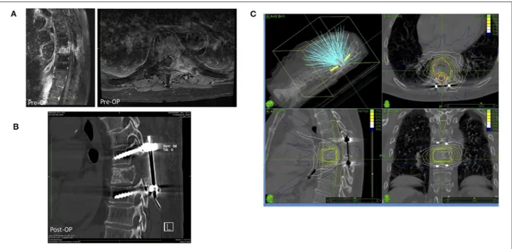 FIGURE 3 | A representative case for a hybrid therapy with a prior surgery including decompression and stabilization followed by a radiosurgical treatment by Cyberknife