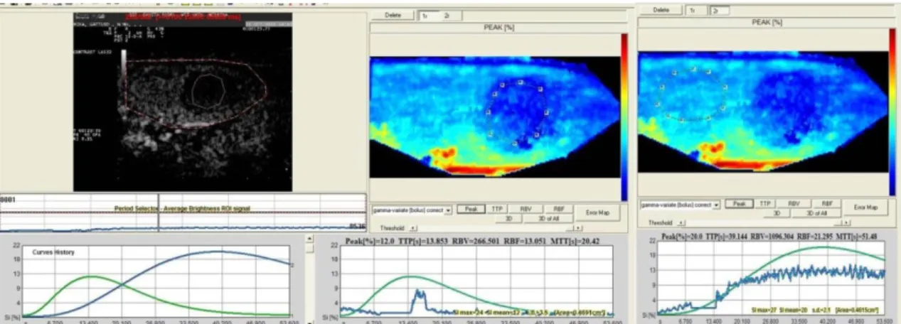 Figure 3.2 Quantitative analysis using Qontrast® of BNH in clinical case n°=8. Two  ROIs  are  created  and  generate  different  TICs:  one  ROI  is  located  in  to  the  lesion  and  another  one,  with  similar  dimension,  in  the  normal  parenchyma