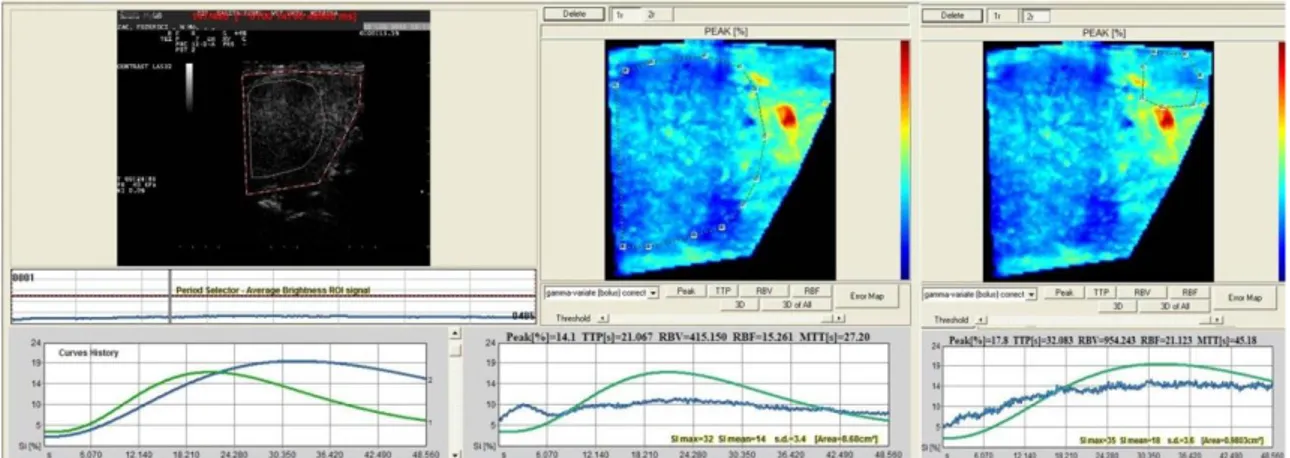 Figure  3.6  Hemangiosarcoma  quantitative  analysis  using  Qontrast®.  One  ROI    is  located in lesion and one in normal parenchyma: two different TICs were obtained and  different data for Peak, TTP, RBV, RBF, MTT