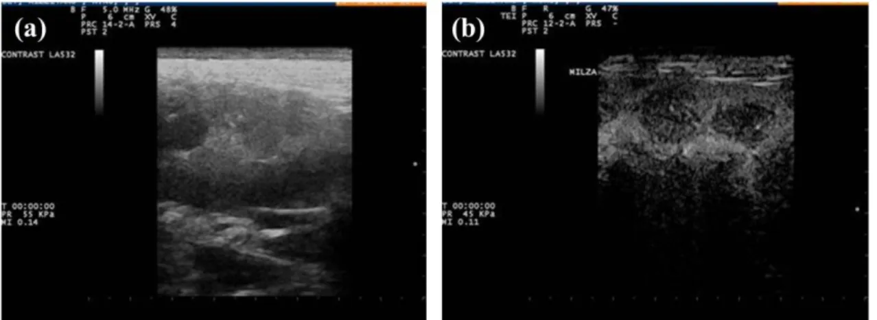 Figure  3.9  Histiocytic  Sarcoma  in  spleen.  B-mode  appearance  of  nodular  lesions:  diffuse  and  hypo-echoic  (a)  confirmed  on  CEUS  like  a  diffuse  hypo  enhancement  of  nodular areas (b)