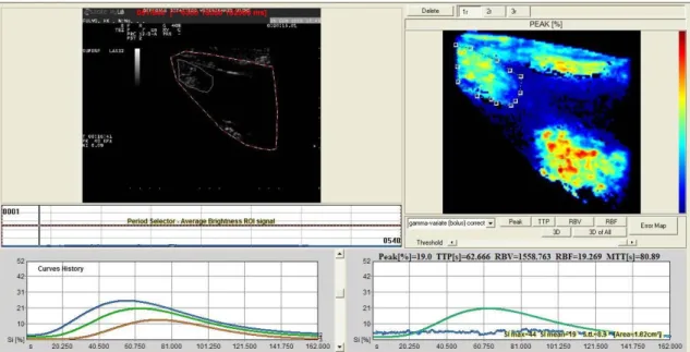 Figure 4.2 Quantitative analysis of physiological bladder cases  (clinical case n=3).  Quantitative  analysis  of  Wall  and  Mucosa  of  a  physiologic  example,  with  creation  of  one  ROI  including  both