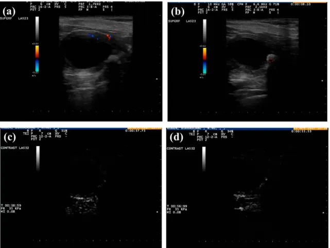 Figure  4.5  Inflammatory  lesion  case  in  bladder  wall.    B-mode  and  Colour  Doppler  image is showed and reveal the presence of a lesion in bladder wall hyper-echoic with  shadow and with a low Doppler signal(a)(b) and CEUS reveal the bladder  wall
