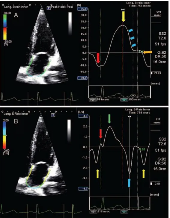 Figure 2 Left atrial strain and strain rate in a normal subject  