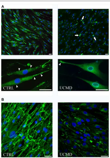 FIGURE 3 | (A) Immunofluorescence microscopy of COLVI antibody in normal (CTRL, left panels) and UCMD patient (UCMD, right panels) tenocyte cultures treated with ascorbic acid for 24 h