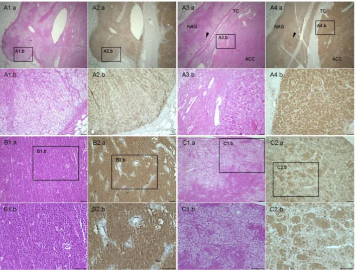 Figure 3: Hematoxylin &amp; eosin and livin staining in adrenal samples.  (A) Normal adrenal gland (NAG) (A.1–2) with adjacent  adrenocortical carcinoma (ACC) (A 3-4) stained for H&amp;E (A.1 and A.3) and livin (A.2 and A.4)