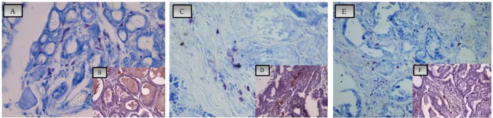 Figura 4: A,B)Elevata presenza di Mastociti nelle aree di iperplasia della ghiandola mammaria, BT(40x), Mast cell Tryptase,(40x);C,D) 