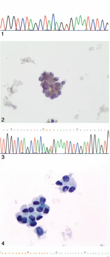 Figure 1. Sequence of p.V600E in a thyroid lesion diagnosed as positive for malignancy on liquid-based cytology.