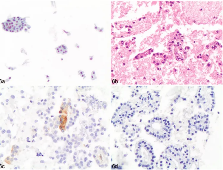 Figure 6. a, Cytologic features of a lymph node metastasis from a prostate adenocarcinoma on liquid-based cytology (LBC)