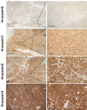 Figure 1. Examples of various intensities of VAV2 staining in ACC specimens. The H-score value is indicated for each image