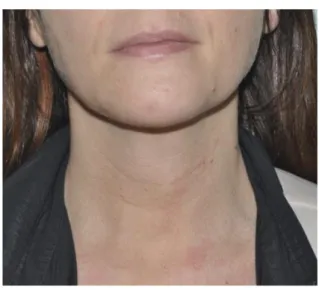 Fig. 3. Cosmetic outcome of a transoral thyroidectomy  