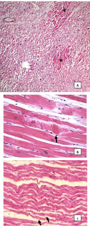 Figure 5. Example of routine histology findings: areas of clear coagulative necrosis (asterisks) associated  with zonas of interstitial edema and wavy myocytes, observed in case n