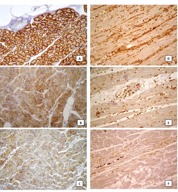 Figure 6. Example of dystrophin and MMP-9 expression. Dystrophin: score 3 observed in case  control group characterized by strong sarcolemmal staining encircling myocytes (A: 40x); score 2 evaluated  in case n