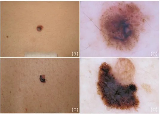 Figure  2.2.  Clinical  and  dermoscopic  appearance  of  two  nevus-associated  melanomas 